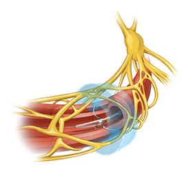 Scientific illustration of the renal vein surrounded by nerves. In the vein in the Peregrine device, and a haze around the vein shows the nerves that are killed by the alcohol emitted by the device.